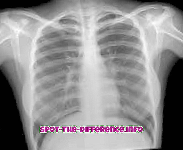 ความแตกต่างระหว่าง: ความแตกต่างระหว่าง X-Ray และ MRI