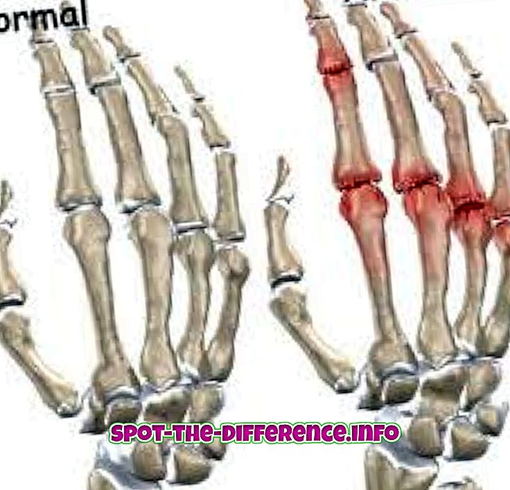 forskel mellem: Forskel mellem arthritis og slidgigt