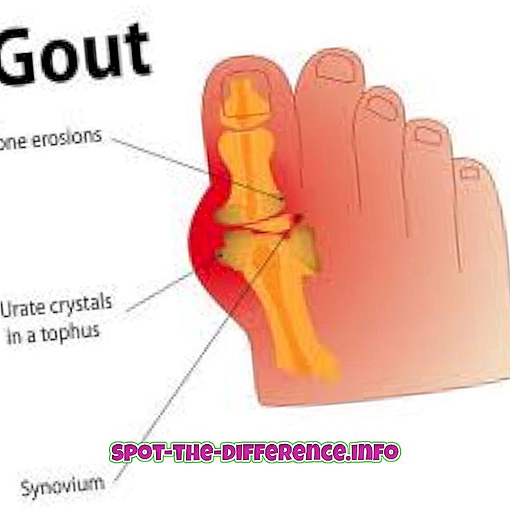 Totul despre guta (artrita gutoasa): Simptome, Factori de risc & Tratament | experttraining.ro