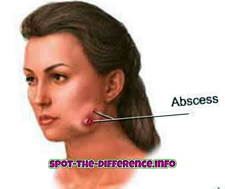 Rozdiel medzi abscesom a vredom