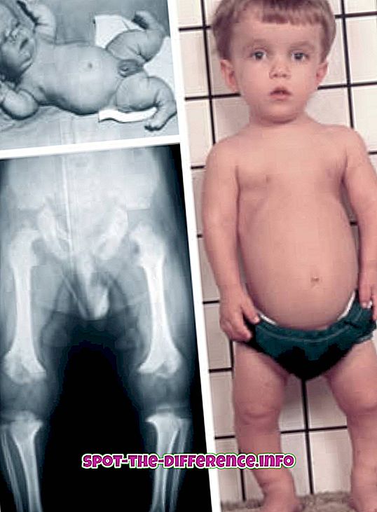 Starpība starp dwarfism un Achondroplasia